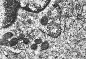 M,41y. | hairy cell leukemia - spleen - ribosome-lamella complex in tricholeukocyte